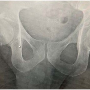 Right Hip Fracture