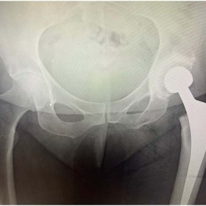 Treated Left Total Hip Replacement