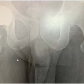 Treated with Total Hip Replacement