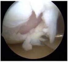 Severely damaged articular cartilage